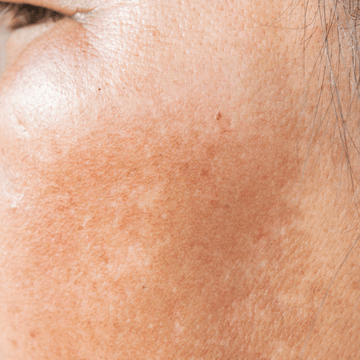 Mitos e verdades sobre o Melasma: separando fatos da ficção - L'Amazonie Skincare